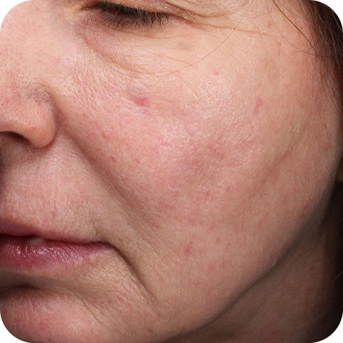 Before and After Images of Flawless Palm Beach Med Spa Clients in West Palm Beach, FL, Royal Palm Beach, FL, and Lantana, FL Before and After Images of Flawless Palm Beach Med Spa Clients in West Palm Beach, FL, Royal Palm Beach, FL, and Lantana, FL