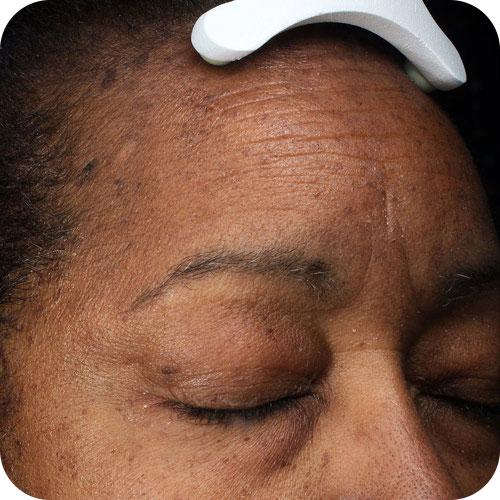 Before and After Images of Flawless Palm Beach Med Spa Clients in West Palm Beach, FL, Royal Palm Beach, FL, and Lantana, FL Before and After Images of Flawless Palm Beach Med Spa Clients in West Palm Beach, FL, Royal Palm Beach, FL, and Lantana, FL
