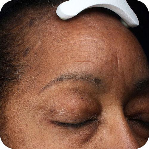 Before and After Images of Flawless Palm Beach Med Spa Clients in West Palm Beach, FL, Royal Palm Beach, FL, and Lantana, FL Before and After Images of Flawless Palm Beach Med Spa Clients in West Palm Beach, FL, Royal Palm Beach, FL, and Lantana, FL