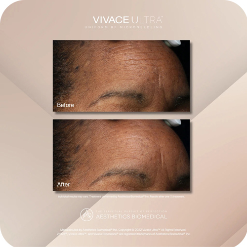 Vivace Ultra in West Palm Beach, FL, Royal Palm Beach, FL, and Lantana, FL