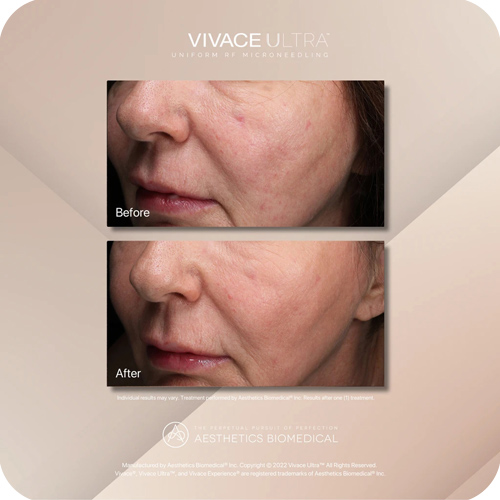Vivace Ultra in West Palm Beach, FL, Royal Palm Beach, FL, and Lantana, FL