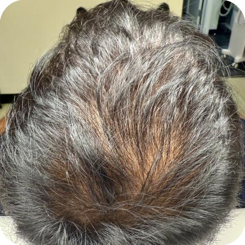Before and After Images of Flawless Palm Beach Med Spa Clients in West Palm Beach, FL, Royal Palm Beach, FL, and Lantana, FL Before and After Images of Flawless Palm Beach Med Spa Clients in West Palm Beach, FL, Royal Palm Beach, FL, and Lantana, FL
